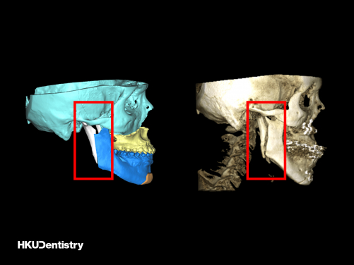 Intraoral vertical ramus osteotomy (IVRO): (Left) The pre-operative virtual surgical planning (red frame); (Right) The post-operative CT scan (red frame).